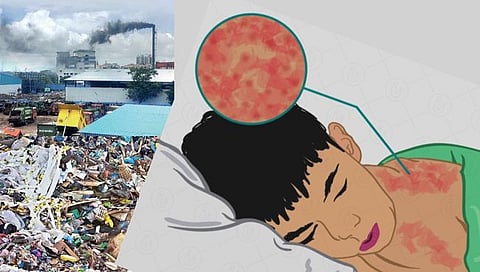 Mumbai : जैविक कचरा उचलणारी कंपनीच गोवर रोगाला कारणीभूत