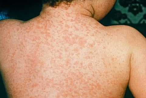 पुणे : गोवरच्या उद्रेकामुळे आरोग्य विभाग ‘अॅक्शन मोड’वर