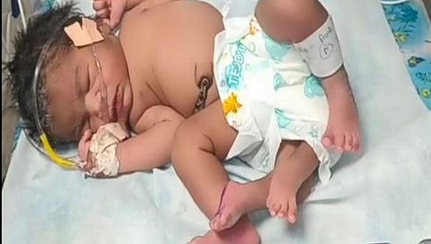 Woman gives birth to baby girl with 'four' legs in MP's Gwalior