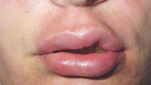 एंजिओएडेमाच्या अंतरंगात…