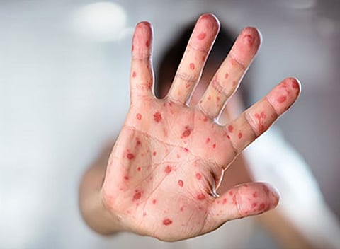 शहरात गोवरचा उद्रेक ! पाच बालके संशयित रुग्ण