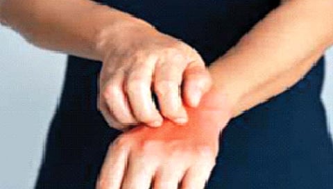 scabies : तुम्हालाही त्वचेला सतत खाज सुटते का? जाणून घ्या कारण…