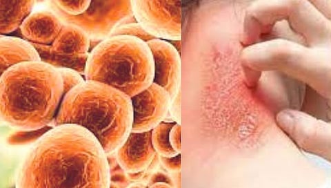 Fungal Diseases : ५.७२ कोटी भारतीय बुरशीजन्य आजारांनी ग्रस्त; फंगल इन्फेक्शन कॅन्सरहून घातक