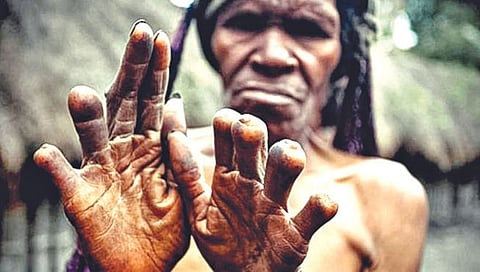 घरात मृत्यू झाला की, कापतात महिलांची बोटे; मृत पावलेली व्यक्ती भूत होऊन छळू नये म्हणूनची परंपरा