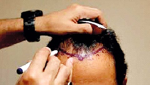 आता डेंटिस्टही करू शकणार हेअर ट्रान्स्प्लांट