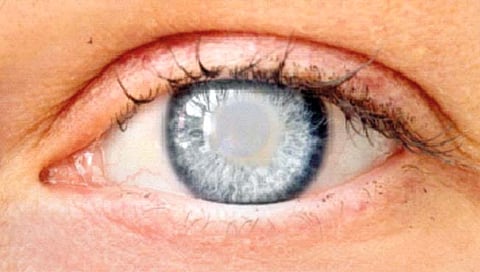 मोतीबिंदू आणि आयुर्वेद