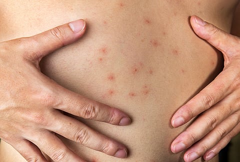 पुणे : शरीरावरील पुरळ, फोड संसर्गजन्य नाहीत : डॉ. अब्दुल रझाक