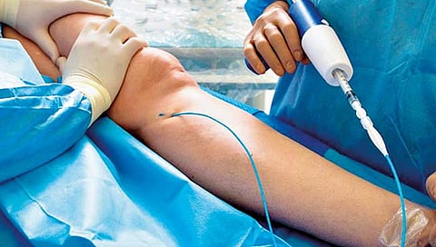 व्हेरिकोज व्हेन्सची समस्या आणि उपचार, जाणून घ्या सविस्तर