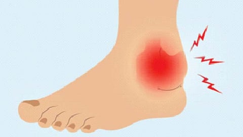 पायावर सूज, घ्यावयाची काळजी अन् नैसर्गिक उपचार