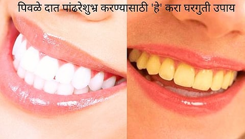 Teeth Whitening Tips