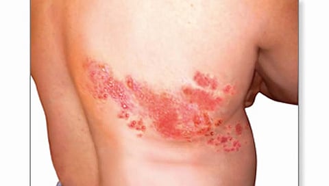 नागीण : गैरसमज नकोत; उपाय हवेत!