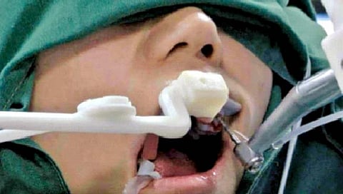 तोंडातून दात काढणारा ‘एआय’ रोबो