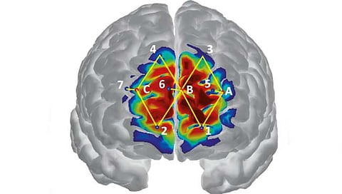 संशोधन : जुन्या दुखण्याची तीव्रता आता मोजता येणार; प्रथमच दिसल्या मेंदूतील तीव्र लहरी