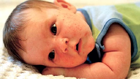 Children’s Health : बाळाच्या अंगावर पुरळ उठल्यास…