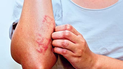 एक्झिमा संसर्ग : कारणे आणि उपचार