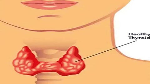 तिशीतच थायरॉईडची व्याधी; रुग्णांत 80 टक्के महिला; बदलत्या जीवनशैलीचा परिणाम, व्यायाम, आयोडिनची कमतरता