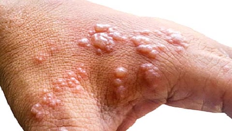 मुकाबला हार्पिसचा