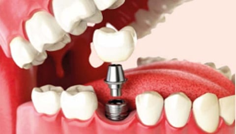 Dental Implant Surgery : पर्याय दातांच्या प्रत्यारोपणाचा…