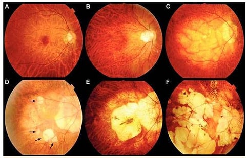 डोळ्यांत लाल डाग दिसत असल्यास…