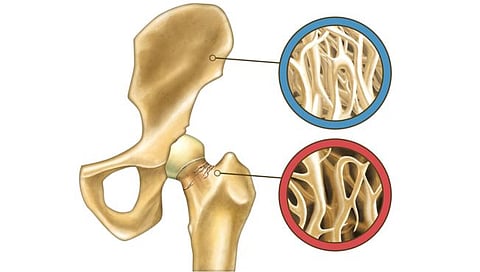 Osteopenia : हाडांच्या ‘ऑस्टियोपीनिया’ने त्रस्त आहात? हे आहे कारण…