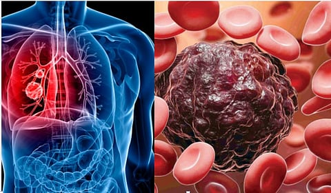 पुणे : कर्करोगावर मात केल्यावर जीवनशैलीतील बदल आवश्यक