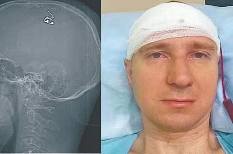 स्वप्नांवर नियंत्रणासाठी स्वतःच आपल्या मेंदूत केले इलेक्ट्रोड प्रत्यारोपण!