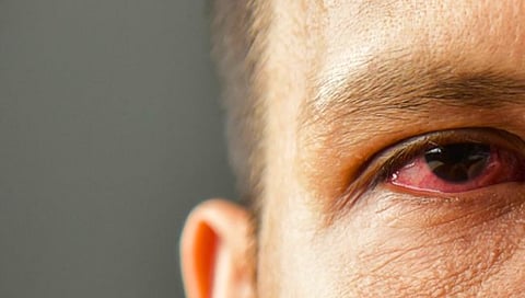 Conjunctivitis Eye Infection | पसरतेय डोळे येण्याची साथ, संसर्ग टाळण्यासाठी अशी ‘घ्या’ काळजी