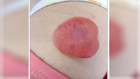 खांद्यावर आला लाल जेलीसारखा ट्यूमर!