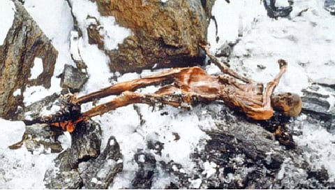पाच हजार वर्षांपूर्वीचा ‘ओत्झी’ होता टक्कलग्रस्त?