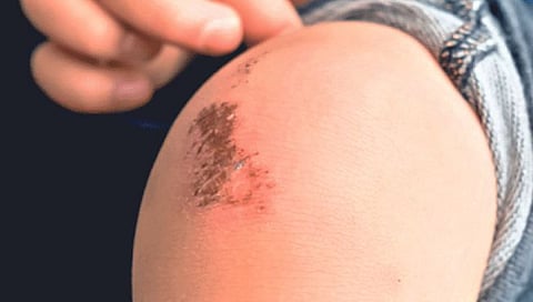 Wound : जखम लवकर बरी होण्यासाठी…