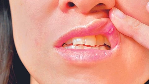 Mouth Sores : तोंड येण्याचा त्रास हाेताेय? वेळीच ‘हे’ उपाय करा