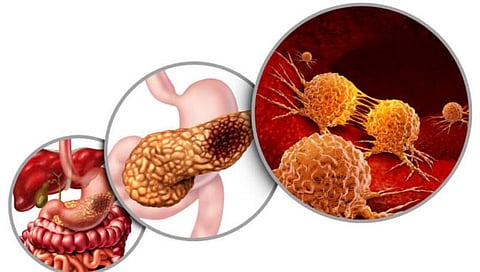 Pancreatic Cancer : पॅन्क्रिअॅॅटिक कॅन्सरच्या अंतरंगात…