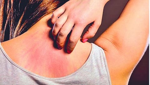 Allergy : काही पथ्ये पाळा,अॅलर्जीला टाळा! जाणून घ्या सविस्तर