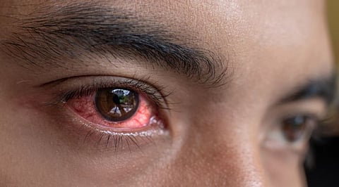 ‘आय फ्लू’ ने पुणेकर त्रस्त ; शहरात 13 हजार जणांना लागण