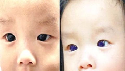 बाळाचे गडद तपकिरी डोळे अचानक झाले निळे