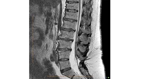 ‘एआय’ने लावला न्यूरोलॉजिकल सिंड्रोम ‘टेथर्ड कॉर्ड’चा छडा