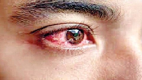 डोळ्यांच्या साथीचा फैलाव