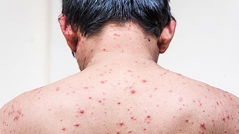 Chickenpox New Variant : भारतात आढळला ‘चिकनपॉक्स’चा नवा व्हेरिएंट, जाणून घ्या काय आहेत लक्षणे ?