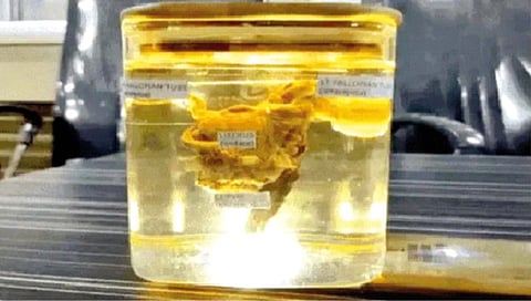 बापरे! तरुणाच्या पोटातून बाहेर काढले गर्भाशय!