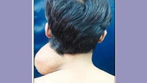 प्लास्टिक सर्जरीने मानेतून काढली सव्वादोन किलोची गाठ