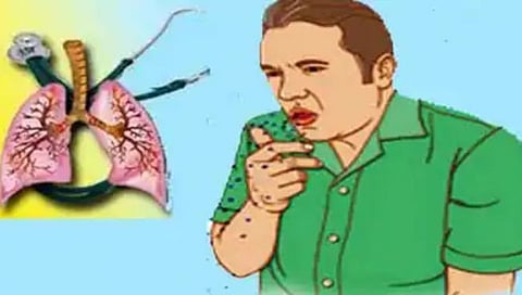 नाशिक शहरात क्षयरुग्ण शोध मोहीम सुरू, १०० पथके ४९ हजार घरांना भेटी देणार