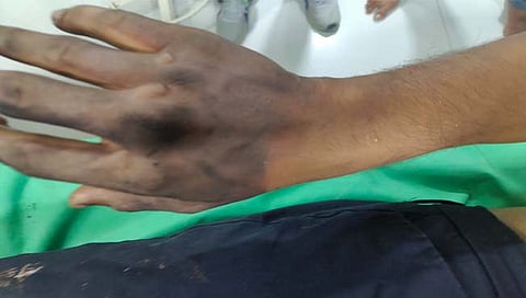 ठाणे : दिव्यात विद्युत वाहिनीचा स्फोट; दोघे जखमी