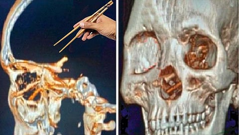 ‘त्याच्या’ नाकात पाच महिने होती चॉपस्टिक!