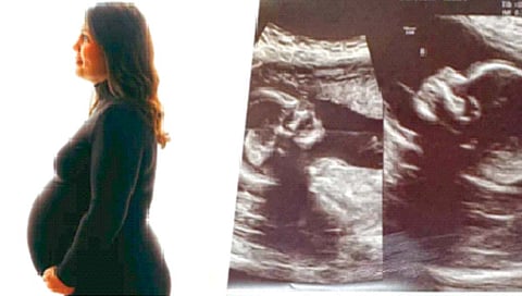 अमेरिकेत महिलेच्या पोटात दोन गर्भाशये, दोन बाळं!