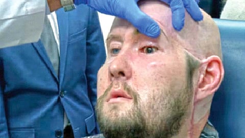 Eye transplant : जगात प्रथमच संपूर्ण डोळ्याचे प्रत्यारोपण