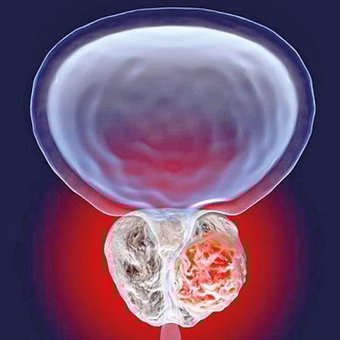 प्रोस्टेट कर्करोगापासून दूर राहण्यासाठी ‘ही’ काळजी घ्या