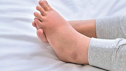 water retention