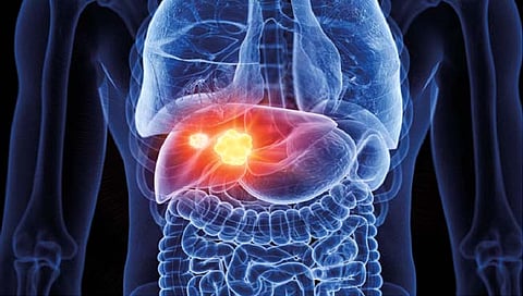 टाळा यकृताचा कर्करोग, जाणून घ्या मुख्य कारणे