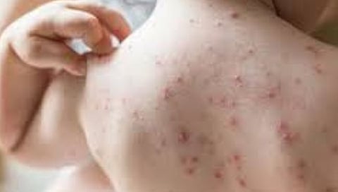 कांजिण्यांपासून बचाव