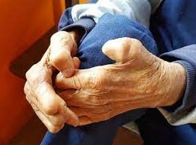 कुष्ठरोगाचे 6 टक्के रुग्ण 18 वर्षांखालील; सार्वजनिक आरोग्य विभागाची माहिती